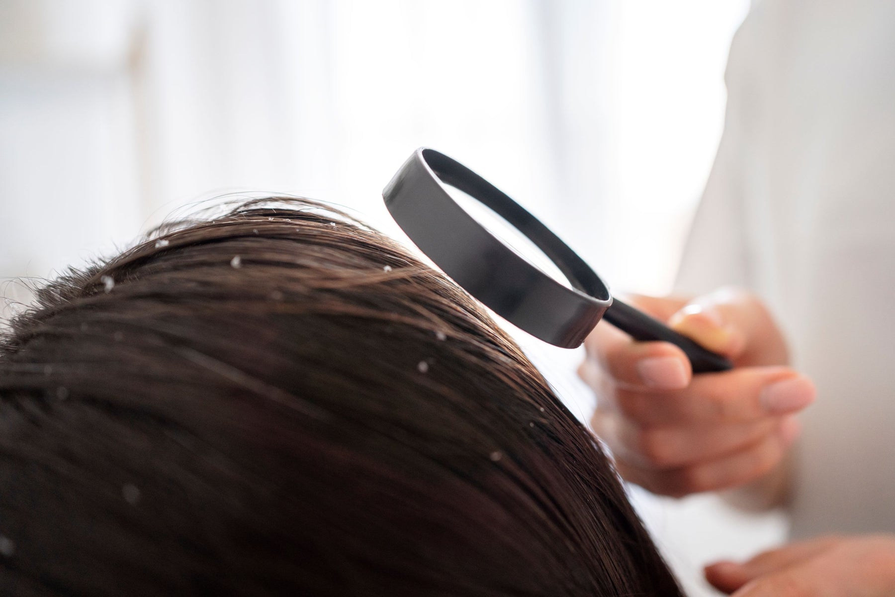 Doù viennent les pellicules dans les cheveux ?